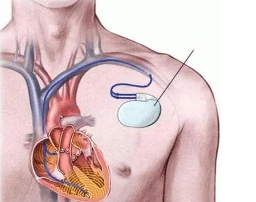 国产起搏器换电池视频,轻松掌握健康守护技能